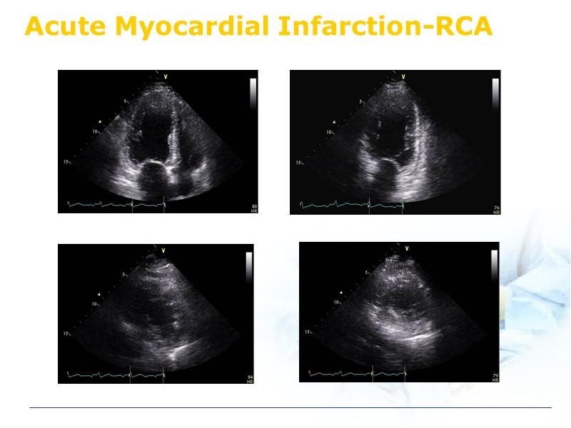 Acute Myocardial Infarction-RCA